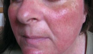 Regina Estética e Cabelo - Rosácea