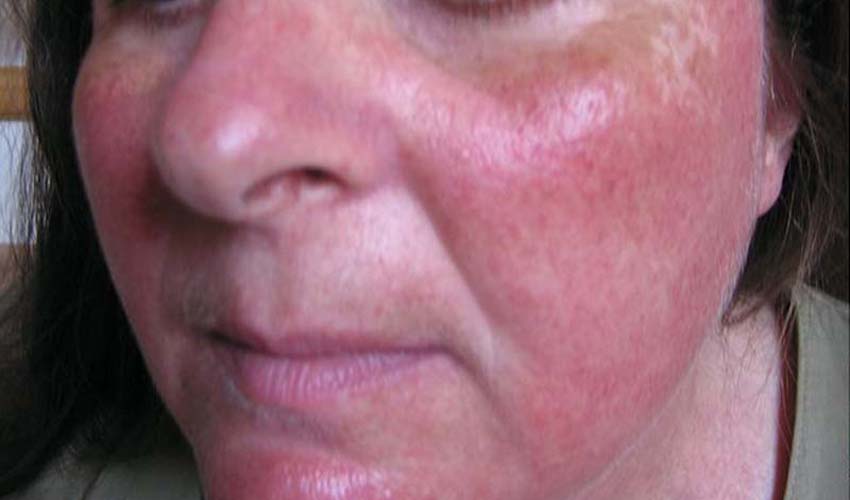 Regina Estética e Cabelo - Rosácea